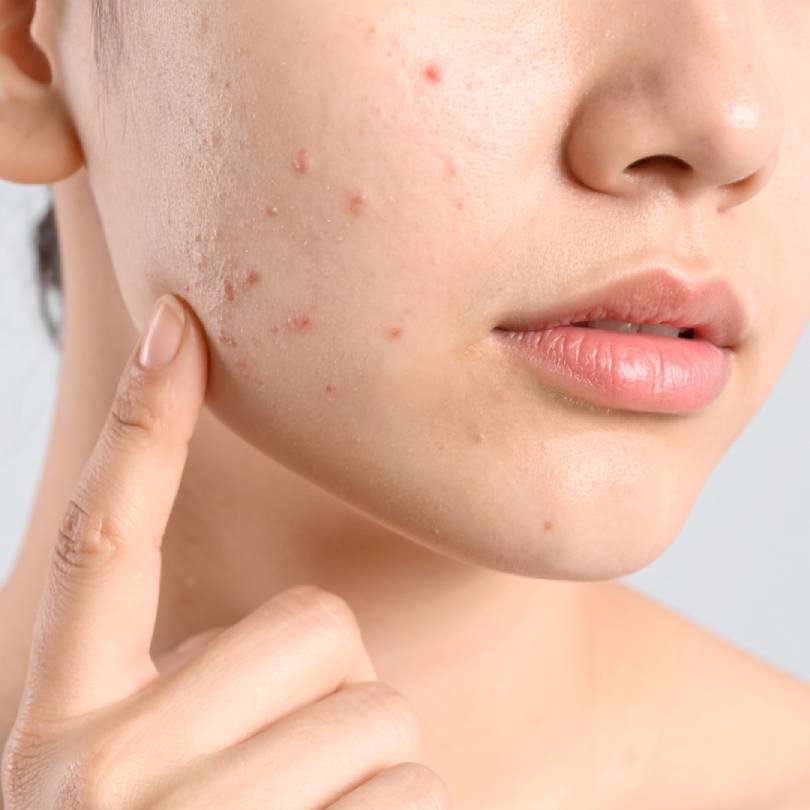 Acne-prone Skin
