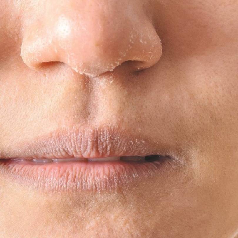 Dull and Dehydrated Skin