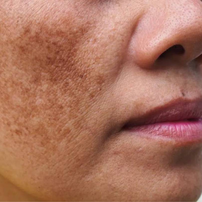 Uneven Skin Tone and Dark spots