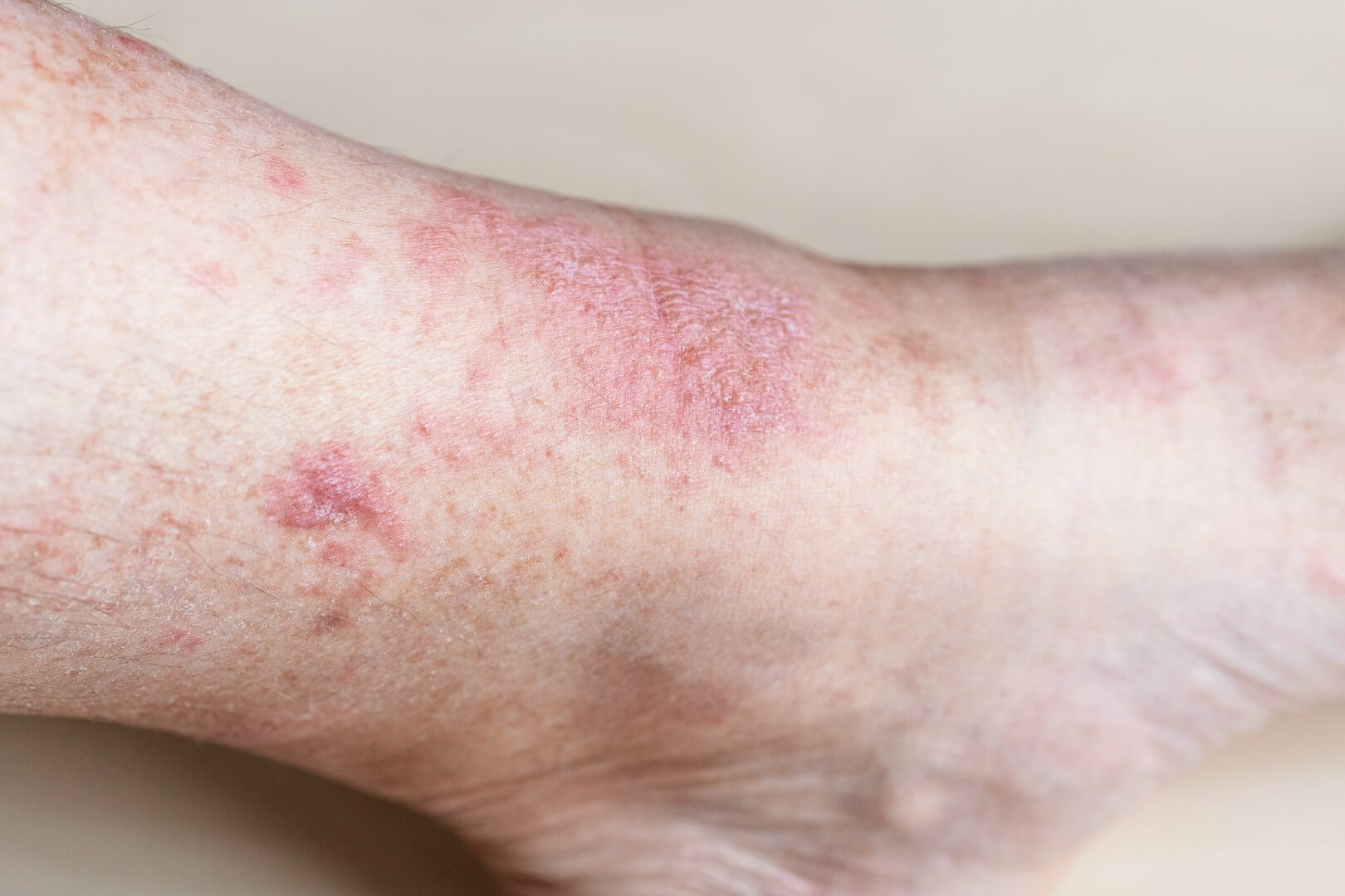 eczema on male shin close up