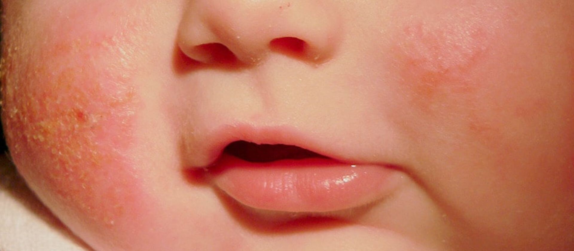 Redefining Skin Health: Clinically Proven Relief for Atopic Dermatitis