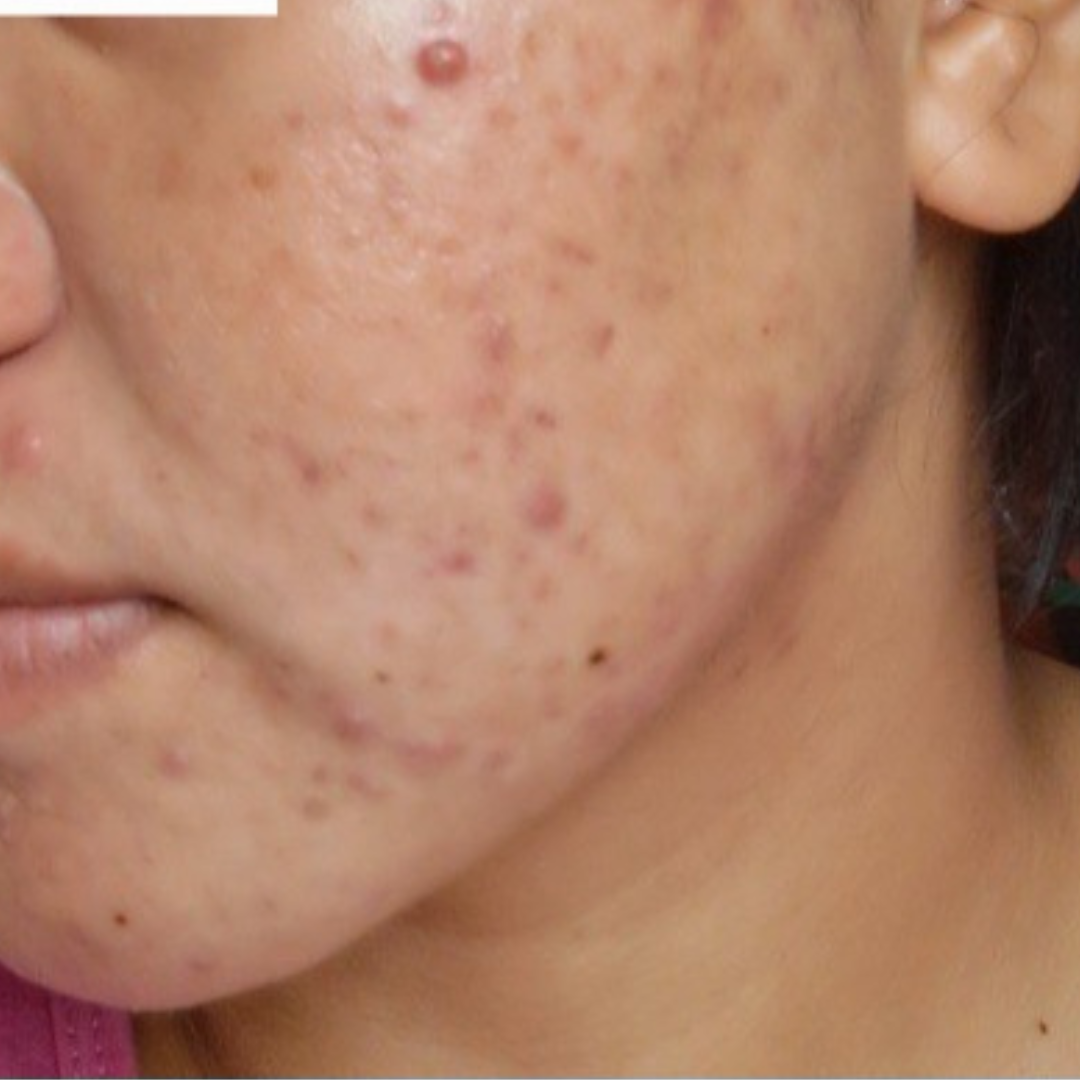 Simple Photo Before and After Skincare Instagram Post (1) Simple Photo Before and After Skincare Instagram Post (1)