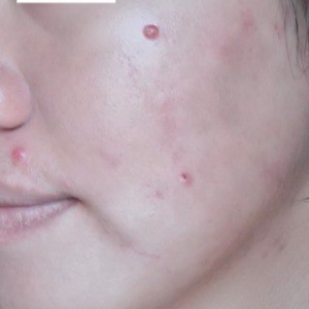 Simple Photo Before and After Skincare Instagram Post (2) Simple Photo Before and After Skincare Instagram Post (2)